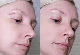 از بین بردن جای زخم